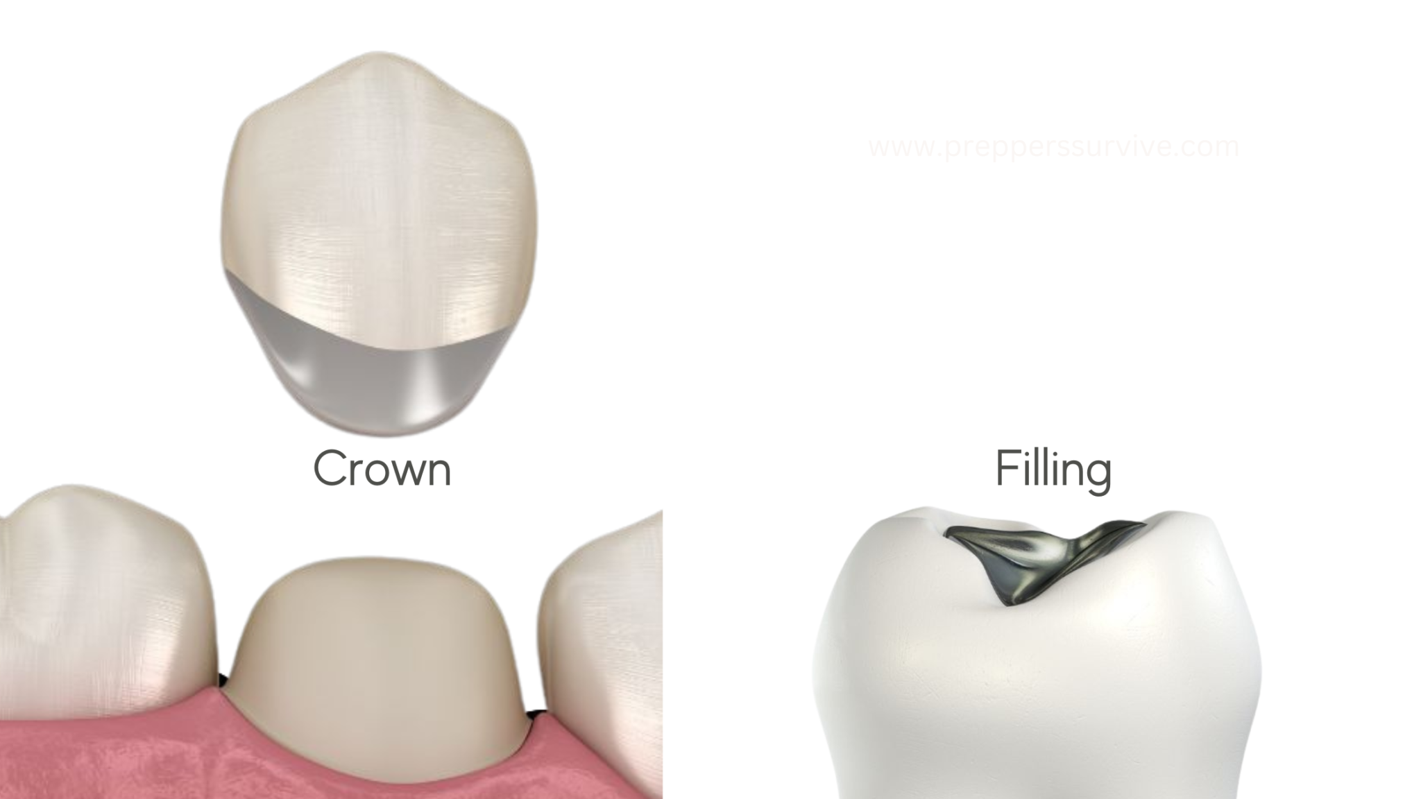 How To Fix A Broken Tooth At Home Survival Prepper